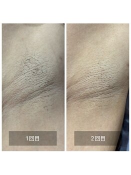 オベリオ(Oberio)/脇脱毛(1回目・2回目/施術前)