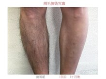 ロイ 梅田茶屋町店(LoY)/あし脱毛