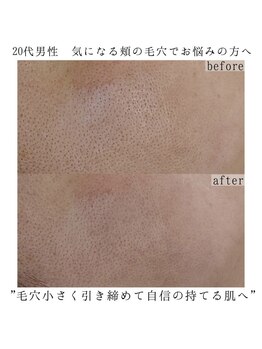 ヴェルシック(Belchic)/毛穴の開きにも有効なハーブ