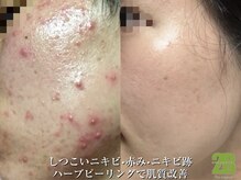 ナンバー19(N°19)の雰囲気（大人気のハーブピーリングでお肌悩みにアプローチ！ニキビケア）