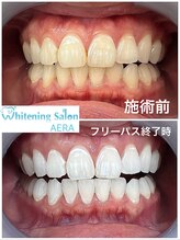 アエラ(AERA)/【歯科衛生士厳選ジェル】効果