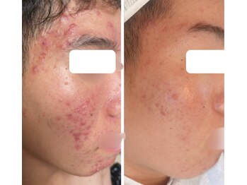 ハクビューティー(HAKU BEAUTY)/思春期ニキビ