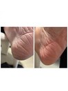 つるすべ☆踵の角質ケア！￥3000