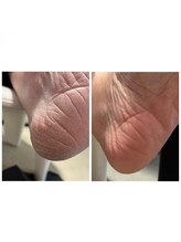 シフォンネイル(Shifon.nail_)/つるすべ☆踵の角質ケア！￥3000