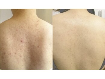 スリリアン 銀座/★ニキビ劇的ビフォーアフター★