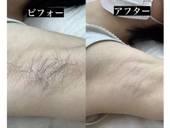 メリアミーゴ(Meli amigo)/脱毛ビフォーアフター