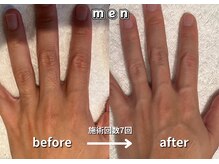 キュー(cue)/【メンズ】「腕脱毛」施術事例