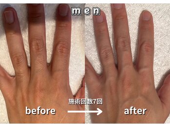 キュー(cue)/【メンズ】「腕脱毛」施術事例