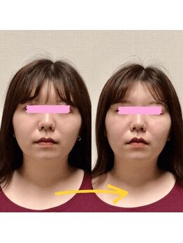 アレイズ/小顔矯正コース