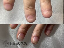 ナンバーアンドスリーサン(No&33)/【深爪】自爪育成