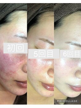 チャーム(CHARM∞)/トラブル肌改善はハーブで！