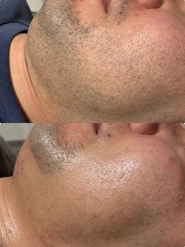 エステ リラクゼーションサロン(more)/【男性】ヒゲ光脱毛