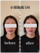 リバイブ 自由が丘店(REVIVE)/小顔矯正＋ドライヘッドスパ１回