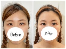 ウニカ(Unica)/BeforeAfter