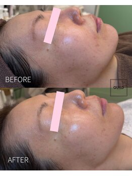 ギルドハナレ(GUILD HANARE)/"プラズマシャワー × シミケア"