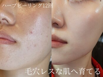 フォア(foi)の写真/ハーブピーリングで肌質改善＆ニキビケア★身体の不調やストレス・毛穴ケア・肌荒れのお悩みにおすすめ◎
