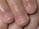 深爪縦長補正1カ月後☆