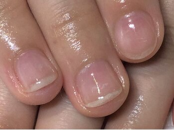 オズ ネイルアンドアイ(OZ NAIL&EYE)/深爪縦長補正1カ月後☆