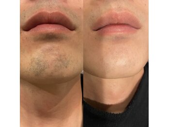 リュクラ オムエピ(Luxla Homme.epi)/ヒゲ脱毛効果