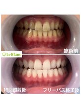 ルブラン 奈良店(Le Blanc)/16回照射後！