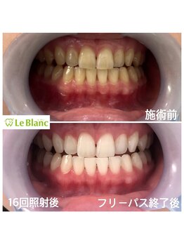 ルブラン 奈良店(Le Blanc)/16回照射後！