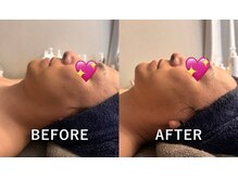 プライム(Prime)/ハーブピーリング