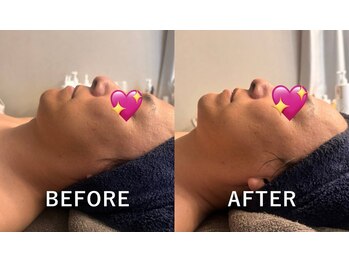 プライム(Prime)/ハーブピーリング