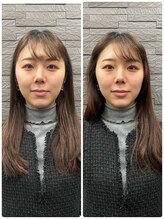 長寿鍼灸院 長寿整骨院/美容鍼25本の効果★小顔効果