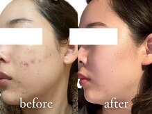 エトワール 横浜馬車道店(ETOILE)/肌質改善|ニキビ・毛穴ケア