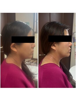 セルビューティー(Cell Beauty)/フェイスラインすっきり。