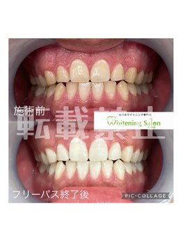 ホワイトニングサロン 札幌店/【ホワイトニング】#札幌#大通り