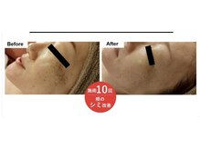 ミセル 尾道店(MYTHEL)/エレクトロポレーション効果