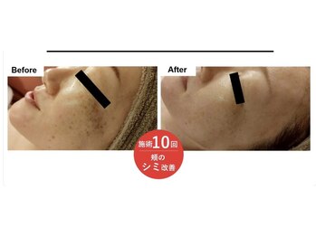 ミセル 尾道店(MYTHEL)/エレクトロポレーション効果