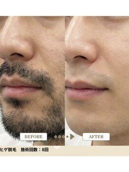 アーユス 健軍店(Ayus)の写真/男性のヒゲ脱毛6,980円!顔全体でこの価格!通常よりも高出力で早く終わる!都度払いで好きな時に通える