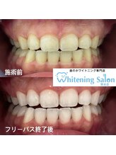 ホワイトニングサロン 熊本店/【ホワイトニング施術例】
