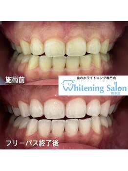 ホワイトニングサロン 熊本店/【ホワイトニング施術例】