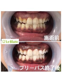 ルブラン 奈良店(Le Blanc)/タバコのヤニも取れ