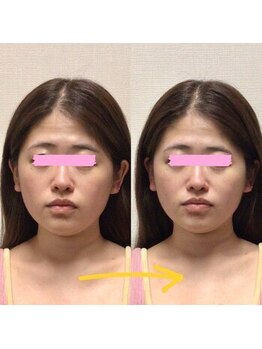 アレイズ/小顔矯正コース