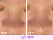 オーシャンブルー 日田店/毛穴の黒ずみケア（毛穴洗浄）