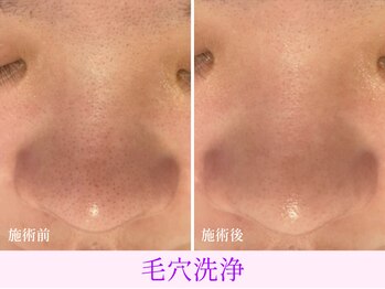 オーシャンブルー 日田店/毛穴の黒ずみケア(毛穴洗浄)