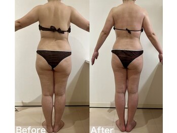 ヴィクシア(VIXIA)/痩身90分