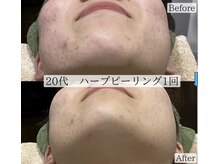 サロン ド ルル(salon de Lulu)/ハーブピーリング