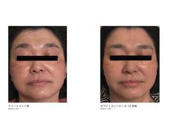 スイ 昭島店(Sui)/ホワイトスノーピール/シミ/美白