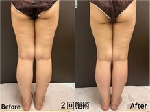 ラ ブリエ(La Briller)/脚のリンパマッサージでスッキリ