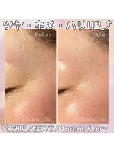 アーキ(ARCHI)/毛穴洗浄＋ヒト幹細胞導入エステ