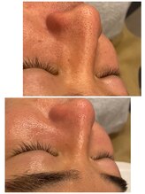 リュクラ オムエピ(Luxla Homme.epi)/毛穴エクストラクション効果