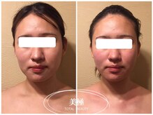 美極 銀座店/銀座/小顔コルギ/小顔矯正