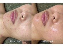 サロンドジェシカ(salon de Jessica)/プラズマ+毛穴洗浄