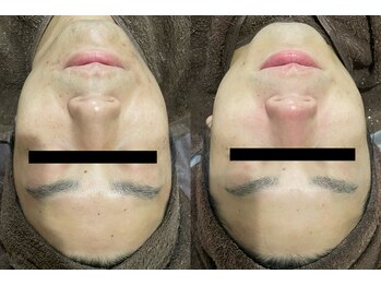 ラヴィアンローズ 泉店 (La vie en Rose)/イロンハーブピーリング