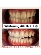 アクア 天王寺店(AQUA)/セルフホワイトニング/天王寺